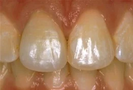 Porcelain Crowns case from the practice's Smile Gallery, after treatment.