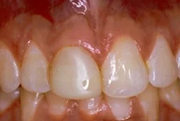 Porcelain Crowns case from the practice's Smile Gallery, before treatment.