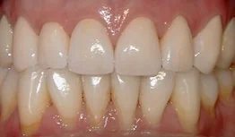 Porcelain Crowns case from the practice's Smile Gallery, after treatment.