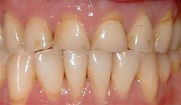 Porcelain Crowns case from the practice's Smile Gallery, before treatment.
