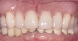 Dentures & Partials case from the practice's Smile Gallery, after treatment.