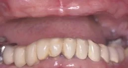 Dentures & Partials case from the practice's Smile Gallery, before treatment.