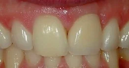Dental Implants case from the practice's Smile Gallery, after treatment.