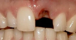 Dental Implants case from the practice's Smile Gallery, before treatment.